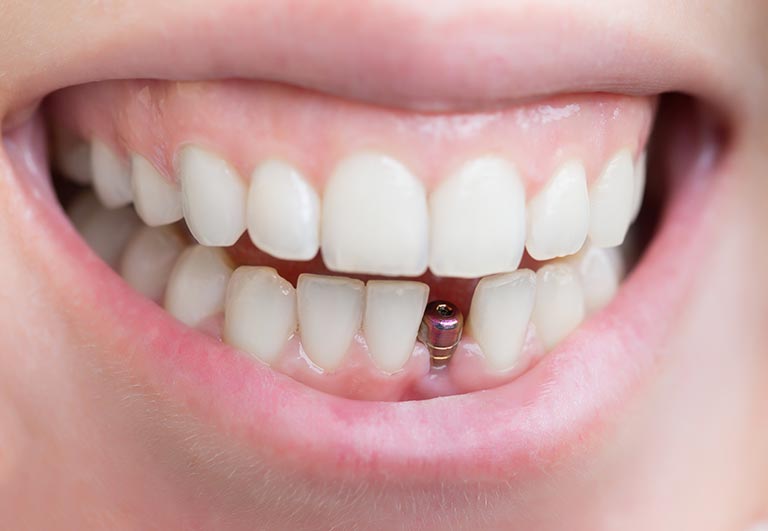 Quelle différence entre un implant dentaire et une couronne [Guide]